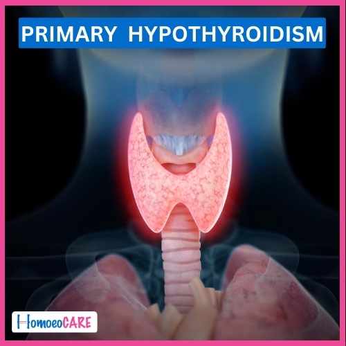 Case study of Successful Treatment of Primary Hypothyroidism by Homeopathy