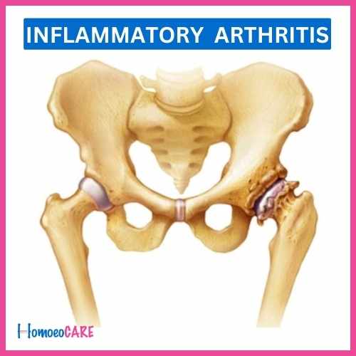 Inflammatory Arthritis