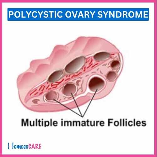 Polycystic Ovary