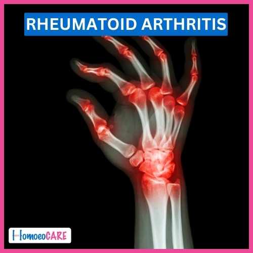 Rheumatoid Arthritis