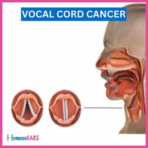 Vocal Cord Cancer