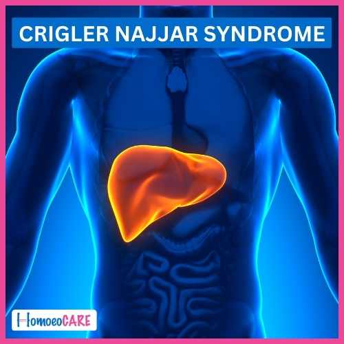 Crigler Najjar syndrome by Homeopathy