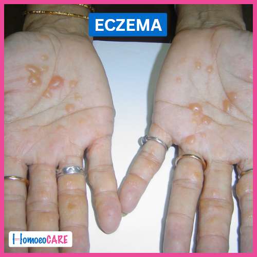 eczema