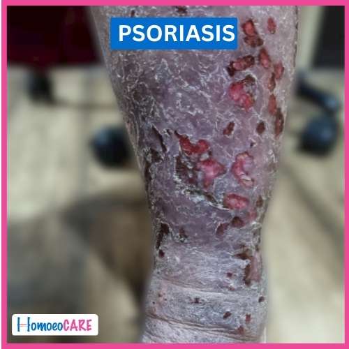 Psoriasis