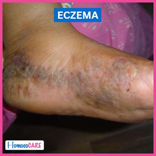 Eczema