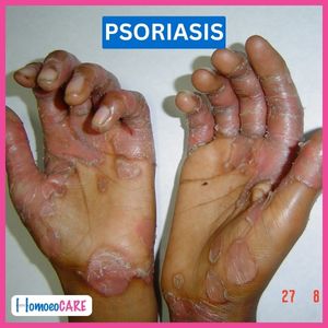 1698408058.before_psoriasis