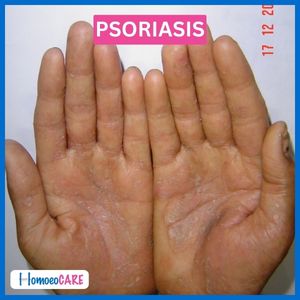 psoriasi_After_Homeopathic_Treatment