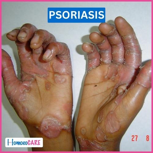 Psoriasis