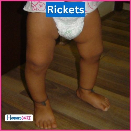 Rickets