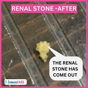 1707802148.Renal-Stone-After