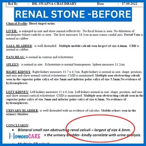 1707802148.Renal-stone-before