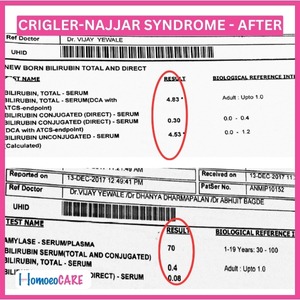 1707805560.Crigler-najjar-Syndrome-After