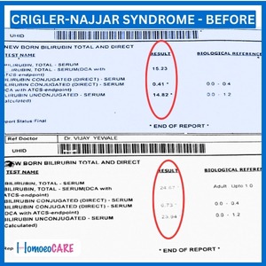 1707805560.Crigler-najjar-Syndrome-before