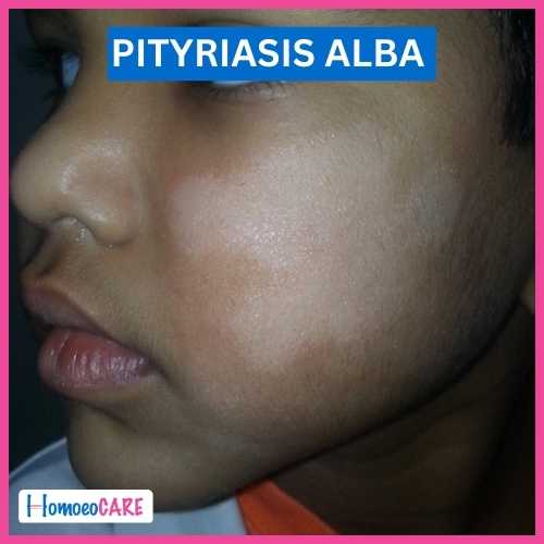 Pityriasis Alba