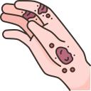 Atopic Dermatitis