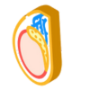 Varicocele