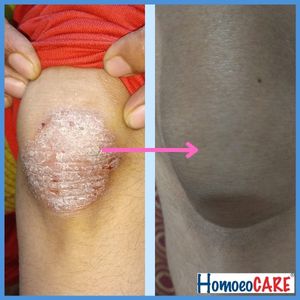 psoriasis on knees