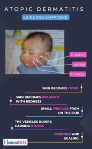 Atopic dermatitis Signs and Symptoms copy