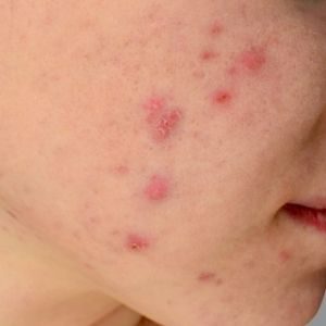 Acne vulgaris