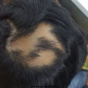 Alopecia_Success_with_homeopathy