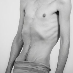 Anorexia nervosaWeight loss