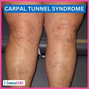 Carpal_Tunnel_Syndrome