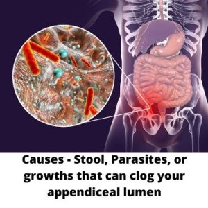 Causes of appendicitis