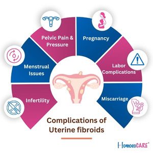 Complications-of-Uterine-fibroids