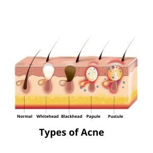 Cross section Acne