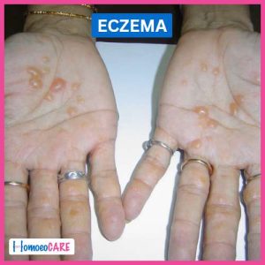 Eczema (2)