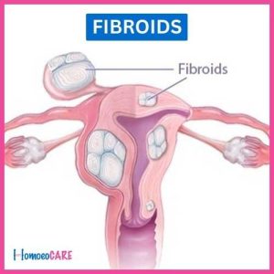 Fibroids