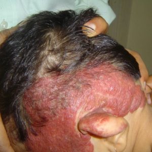 Hemangioma (2)