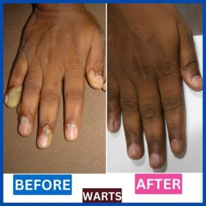 .Homeopathic_treatment_for_warts