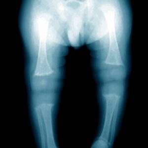 Rickets Xray