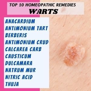 TOP10HOMEOPATHICREMEDIESFORWARTS