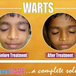 Warts homeopathic treatment case 1