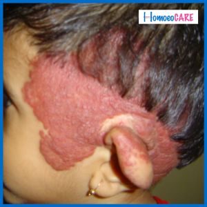 hemangioma (4)