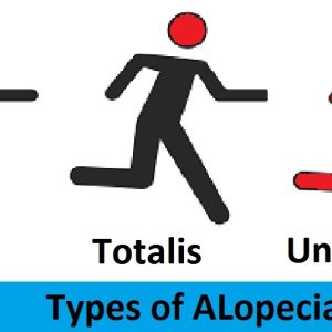 types of alopecia Homeopathic treatment of alopeciai